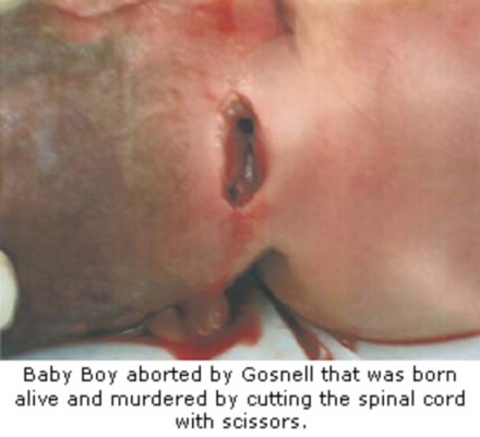 baby-boy-born-alive-and-murdered-by-kermit-gosnell